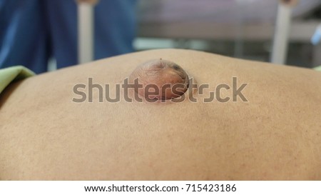 Para Umbilical Hernia.  Central abdominal swelling in adult around the umbilicus due to defect in the layer of abdominal wall.Cough impulse positive.
 Royalty-Free Stock Photo #715423186