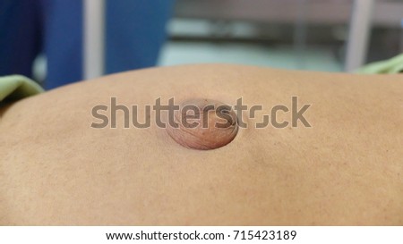 Para Umbilical Hernia.  Central abdominal swelling in adult around the umbilicus due to defect in the layer of abdominal wall.Cough impulse positive.
 Royalty-Free Stock Photo #715423189