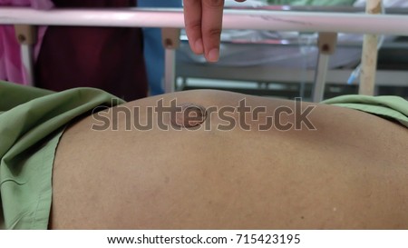 Para Umbilical Hernia.  Central abdominal swelling in adult around the umbilicus due to defect in the layer of abdominal wall.Cough impulse positive.
 Royalty-Free Stock Photo #715423195