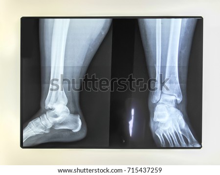 Medical feet bone radiography photo of woman
