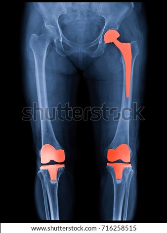 Xray scan of patient who have hip replacement and knee arthroplasty (knee replacement) treatment for Osteoarthritis knee, hip arthritis, Osteonecrosis of Hip. After surgery patient can walk normally. Royalty-Free Stock Photo #716258515