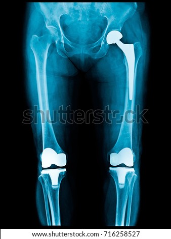 Xray scan of patient who have hip replacement and knee arthroplasty (knee replacement) treatment for Osteoarthritis knee, hip arthritis, Osteonecrosis of Hip. After surgery patient can walk normally. Royalty-Free Stock Photo #716258527