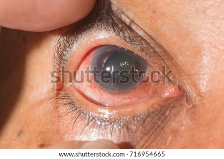 close up of the neo vascular glaucoma during eye examination. Royalty-Free Stock Photo #716954665