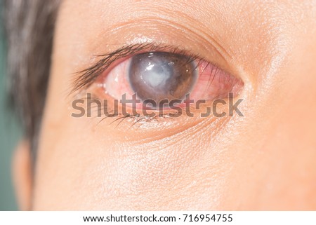 close up of the corneal ulcer during eye examination. Royalty-Free Stock Photo #716954755