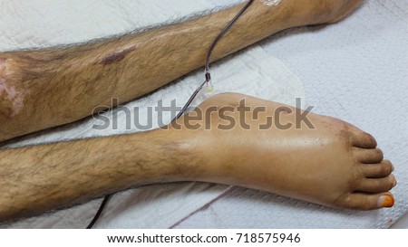 Severe Malnourished due to Chronic Ilnesses. The lower limb showing sign of muscle wasting.