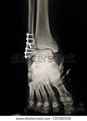 X-ray film of the ankle in AP view. The film shows ankle fracture after open reduction and internal fixation with plate and screw,Medical image concept.