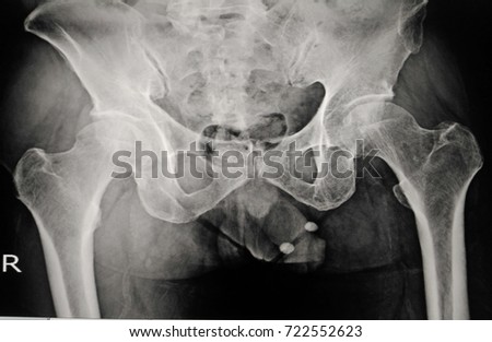 X ray of pelvis showing both femur bone found an abnormality The hip bone is eroded.Medical image concept.
