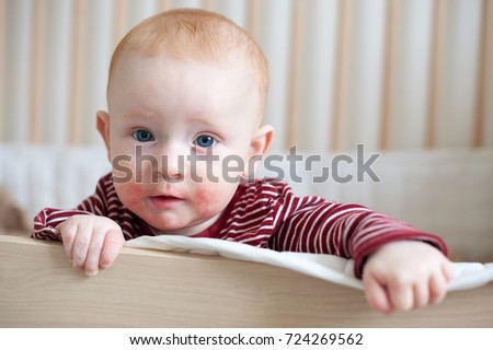 Redhead beautiful baby with atopic dermatitis Royalty-Free Stock Photo #724269562