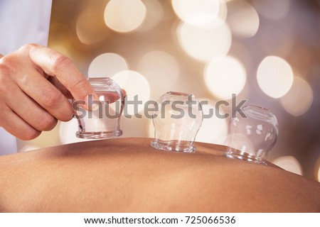 Close-up Of A Person Receiving Cupping Treatment On Back In Spa Royalty-Free Stock Photo #725066536