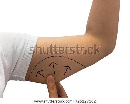female skin on her upper arm and about to perform liposuction, Tricept , Lose weight and liposuction cellulite removal concept Royalty-Free Stock Photo #725227162