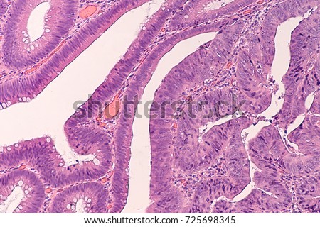 Adenomas are precancerous polyps of colon. This image shows a transition from areas of low grade dysplasia (left) to high grade dysplasia (right). Removing polyps by colonoscopy can prevent cancer.  Royalty-Free Stock Photo #725698345