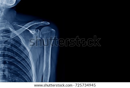 X-ray shoulder good quality