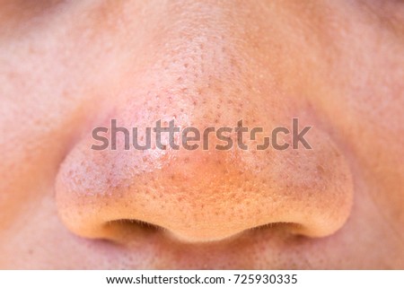 Pimples on the skin of men's nose. Texture Royalty-Free Stock Photo #725930335