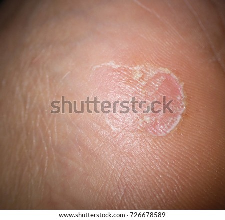 A beginning to fungal infection on the foot
