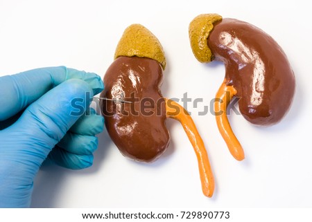 Kidney or renal biopsy or puncture procedure concept photo. Doctor holding puncture needle  and punctures kidney anatomical shape on white table. Renal biopsy operation to obtain tissue for analysis