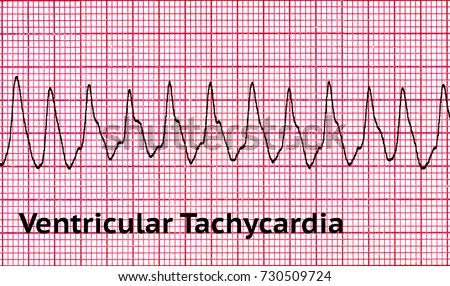 Ventricular tachycardia (VT) is a tachycardia, or fast heart rhythm, that originates in one of the ventricles of the heart. This is a potentially life-threatening arrhythmia. Royalty-Free Stock Photo #730509724