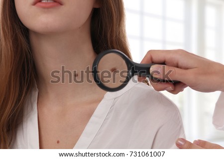 Doctor dermatologist examines birthmark of patient. Checking benign moles. Laser Skin tags removal Royalty-Free Stock Photo #731061007