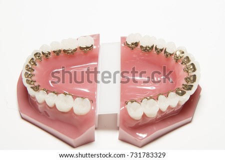 lingual orthodontics Royalty-Free Stock Photo #731783329