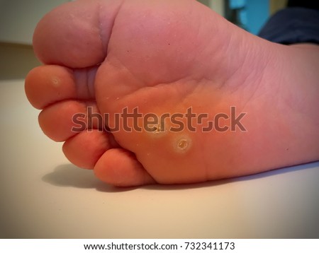 Wart plantar verrucas. Fasciitis or Wart on foot. Verrucas Papilloma Callus Virus Wart Decease on foot skin. Royalty-Free Stock Photo #732341173
