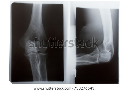 Human elbow in x-ray