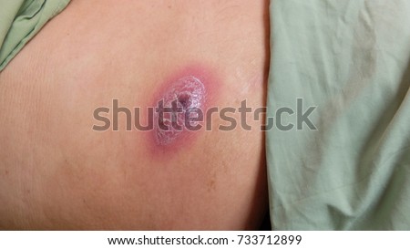 Abscess on the anterior abdominal wall at the site of insulin injection. Royalty-Free Stock Photo #733712899