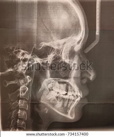 head and neck X-ray film