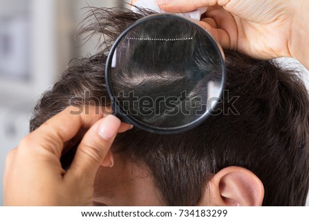 Close-up Of A Dermatologist's Hand Checking Patient's Hair With Magnifying Glass