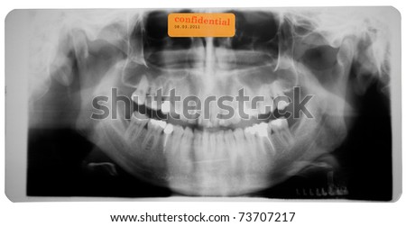 black and white photo of head x-ray