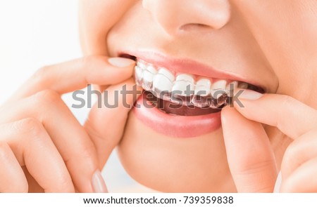 Woman wearing orthodontic silicone trainer. Invisible braces aligner. Mobile orthodontic appliance for dental correction. Royalty-Free Stock Photo #739359838