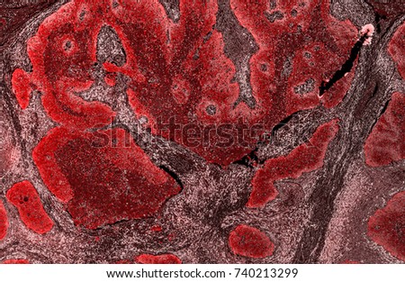 Cells stained with different colors in a false color image of a tumour sample