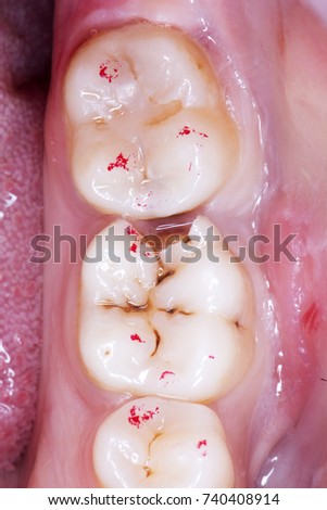 Dental caries. Stage of occlusal contact determination before caries treatment. Royalty-Free Stock Photo #740408914