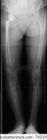 Hip replacement x-ray image