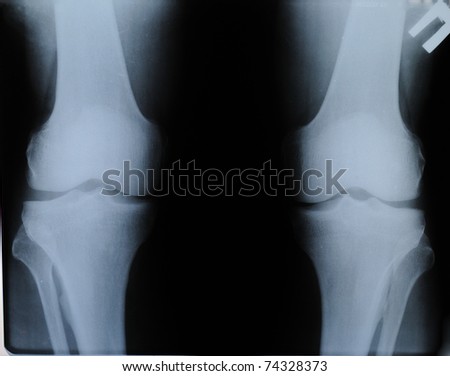 X-ray knees with arthrosis simptomoms