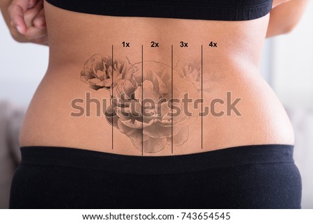 Rear View Of Laser Tattoo Removal On Woman's Hip Royalty-Free Stock Photo #743654545