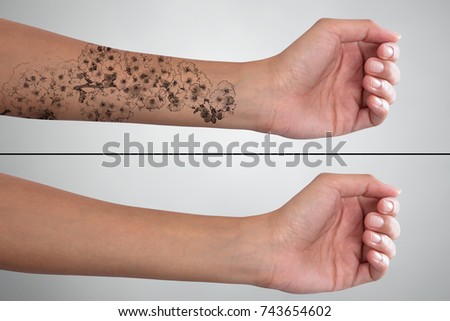 Close-up Of Woman's Hand Before And After Laser Tattoo Removal Treatment Royalty-Free Stock Photo #743654602