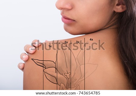 Laser Tattoo Removal On Woman's Shoulder Against White Background Royalty-Free Stock Photo #743654785