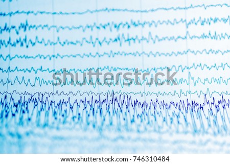 EEG wave in human brain, Brain wave patterns on electroencephalogram,problems in the electrical activity of the brain

