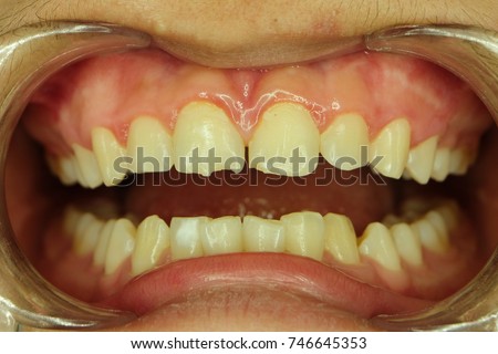 tip of front teeth fracture