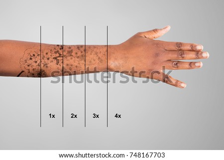 Laser Tattoo Removal On Woman's Hand Against Grey Background Royalty-Free Stock Photo #748167703