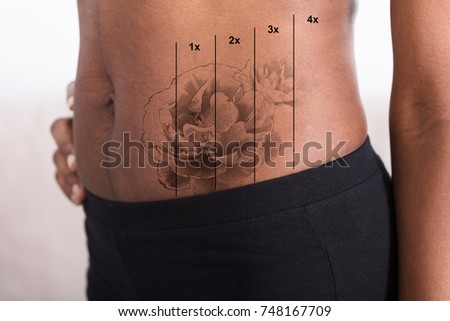 Close-up Of A Laser Tattoo Removal On Woman's Stomach Royalty-Free Stock Photo #748167709