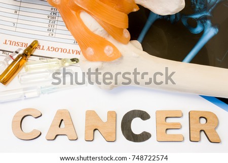 Bone cancer concept. Anatomical shape of femur bone and joint lies near word cancer surrounded by set of tests, analysis, drugs, MRI and stethoscope. Diagnosis treatment of bone cancer, tumor of hip 