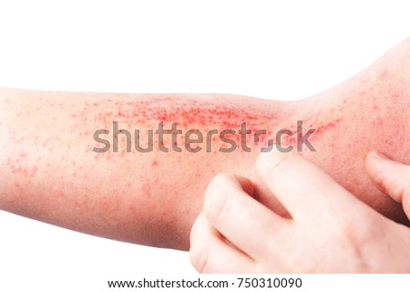 Atopic dermatitis (AD), also known as atopic eczema, is a type of inflammation of the skin (dermatitis) at foot. Royalty-Free Stock Photo #750310090