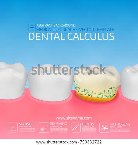 Dental calculus with bacteria. Colorful vector illustration. Infographic template.