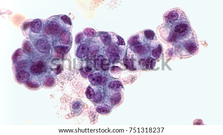 Malignant fluid cytology;   Malignant cells of adenocarcinoma may spread to fluid of  pleural or peritoneal cavity in cancer from the breast,  lung, colon, pancreas, ovary, endometrium or other sites. Royalty-Free Stock Photo #751318237