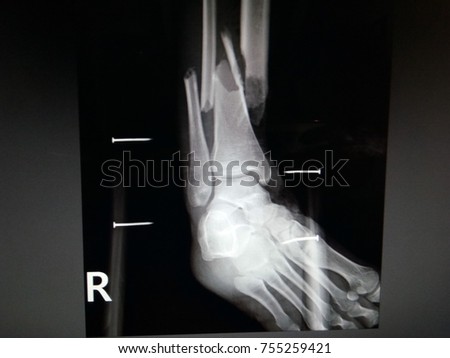 X-ray Broken bone broken leg Royalty-Free Stock Photo #755259421