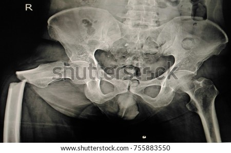  X-ray of the pelvis Thigh Bone broken or Right femur fracture an old human accident slipping on different floors,Medical healthcare concept Royalty-Free Stock Photo #755883550