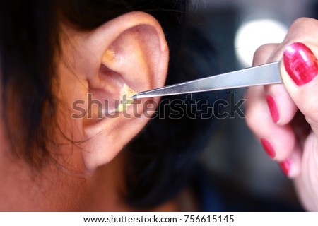 The doctor pulls the earwax out of the Asian man's ear. With stainless steel pliers. Royalty-Free Stock Photo #756615145