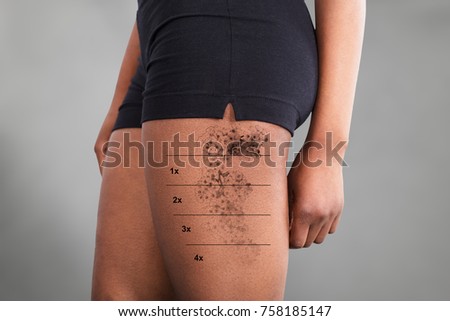 Midsection View Of A Laser Tattoo Removal On Woman's Thigh Royalty-Free Stock Photo #758185147