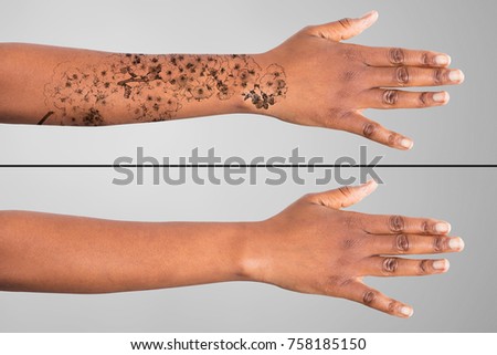 Laser Tattoo Removal On Woman's Hand Against Grey Background Royalty-Free Stock Photo #758185150