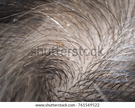 Lice In Hair. Macro. The look in the hair of the larvae, nits, lice